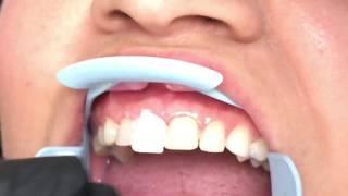 Houston Cosmetic Dentist...Lumineers ...Smile Transformation and Minimal Prep