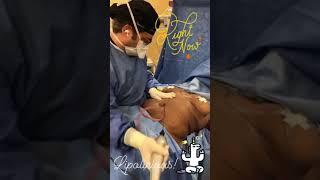 3 area liposuction with Renuvion | Liposuction review | DrJeneby #Shorts