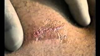 Wound Treatment of a Fresh Laceration