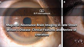 Magnetic Resonance Brain Imaging in Late Onset Wilson’s Disease Clinical Features and Review