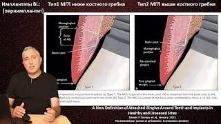 Мягкотканная интеграция имплантата (часть 6) Прикрепленная десна.