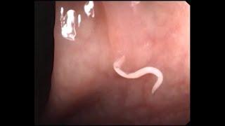 pin worms in colon on high definition colonoscopy
