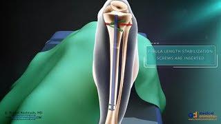 Precice Tibia Lengthening Surgical Animation