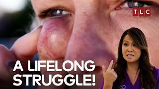 Every Blink Feels Like a Battle! | Dr Pimple Popper TLC