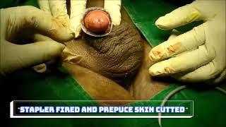 Stitchless,Bloodless Circumcision, ForeSkin Removal, Pennies Reconstruction, Surat, Mumbai, India