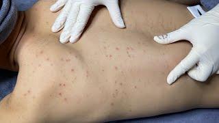 ACNE TREATMENT VU QUYNH MI | Acne On Boy's Back 2024