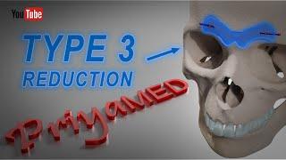 Type 3 Brow Boss Forehead Reduction... At PriyaMED.