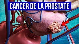 CANCER DE LA PROSTATE : Explication, Symptômes et Traitements