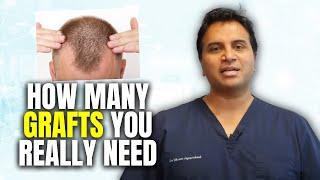 How To Determine The Number of Grafts Required In a Hair Transplant Procedure