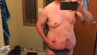 My 8th day post umbilical ventral hernia repair update 2016