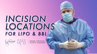 Incision Locations for LIPO and BBL