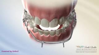 Tandem Appliance - Orthodontic Treatment