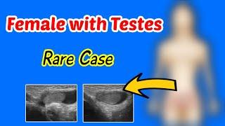 Female with testes (rare case)