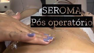 SEROMA na segunda semana de cirurgia plástica/ abdominoplastia