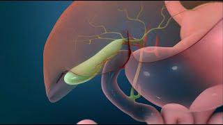 Surgery to Remove Your Gallbladder (Open Cholecystectomy)