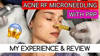 Microneedling for Acne | Vampire Facial PRP & RF