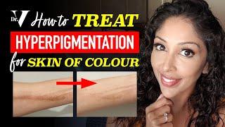 DOCTOR V's HOW TO TREAT HYPERPIGMENTATION for SKIN OF COLOUR | BROWN/ DARK SKINCARE | DR V soc