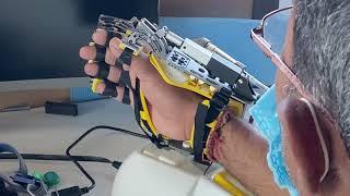 Most Advance physiotherapy for hand paralysis │ hand robot │Ahmedabad │Brain stroke │Ph:09941081080