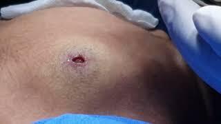 Epidermal Inclusion Cyst Retention Cyst: Micro-Incision Excision