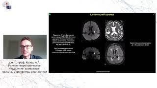 Раннее неврологическое ухудшение: возможные причины и алгоритм  диагностики. д.м.н., проф. Кулеш А.А