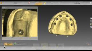 inLab SW 15 Screw-Retained Multi-Unit Bridge Workflow