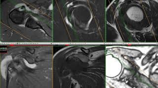 МРТ плеча разрыв надостной мышцы и не только