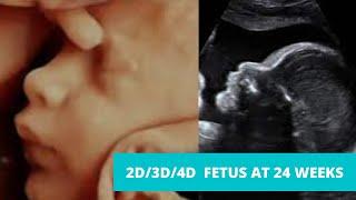 2D/3D /4D Ultrasound at 24 weeks pregnancy (video)