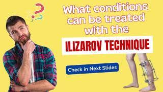 In Which Deformities The Ilizarov Technique can Help?