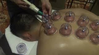 Cupping and Quasha Therapy Demonstration part 1 by rex parcon