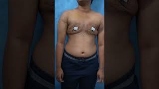 Keyhole FTM Top Surgery Result After 5 days #shortsvideo