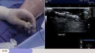 Venclose™ RF Ablation Catheter Procedure Video