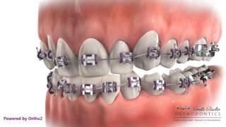 Bite Plate Avoid Breakage - Orthodontic Treatment