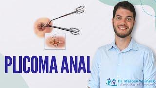 Plicoma anal. O que é? Como tratar?