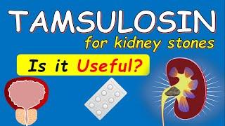 Tamsulosin for Kidney Stones - 6 Things to Know