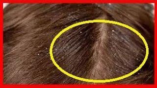 Liendres del cabello como eliminarlas