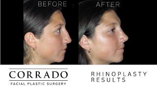 EASY RECOVERY After Rhinoplasty Surgery: Patient Experience | Dr. Anthony Corrado