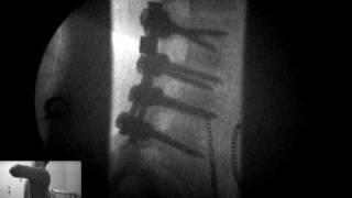 DMX | Herniated disc | Vancouver Wa | Portland OR| Chiropractic| DRX 9000