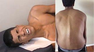 Chiropractor CHANGES LIFE for TEENAGER w/ HUNCHBACK & DEAD LEG