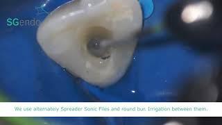 Rotary Files in Endodontics | pinkblue