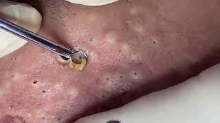 blackheads New this week 2023