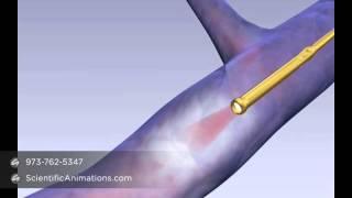 Laser Fiber Treatment - Medical Device Training