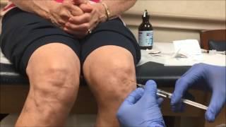 Viscosupplementation Knee Injection