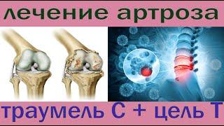 Как эффективно лечить артроз коленного сустава. Схема лечения.