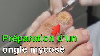 Mycose : Préparation de l'ongle par le Pédicure-Podologue