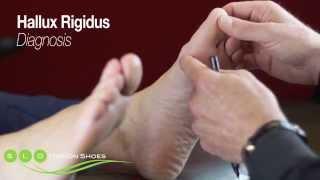 Hallux Rigidus: Causes, Diagnosis, and Treatment