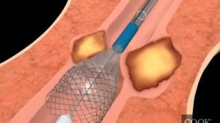 Evolution® Esophageal Controlled-Release Stent – Partially Covered Endoscopic Animation