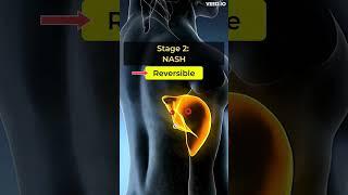 Is My Fatty Liver Reversible? | 4 Stages Of Fatty Liver | What Are Different Stages of NAFLD |