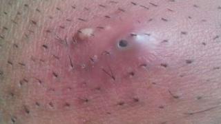 Huge Ingrown Hair from shaving pubic area (HEADPHONE USERS BEWARE)