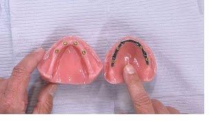 Case of the week: Placing a Removable Lower Denture Attached to Implants