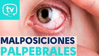 Las malposiciones de los párpados más frecuentes